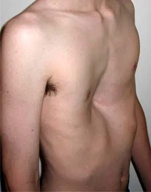 pecho+hundido.bmp