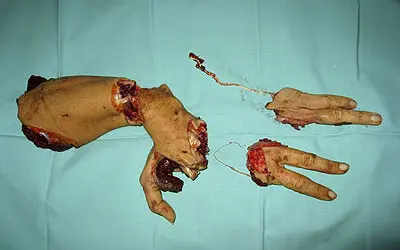 amputaciones.jpg