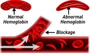 abnormal-hemogl-300x181.jpg