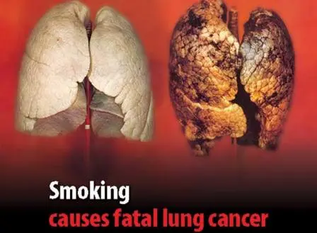 pulmones.jpg