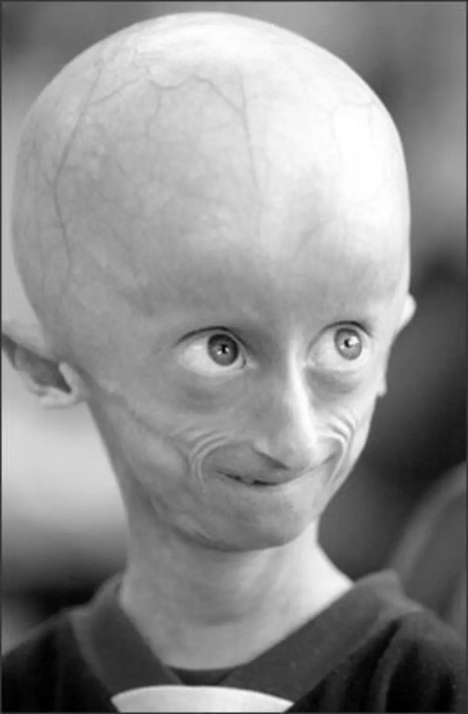 progeria2.jpg