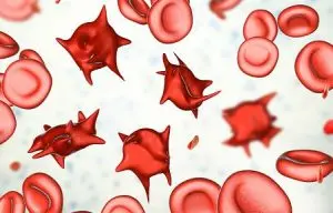 deformed-red-blood-cell-300x192.jpg
