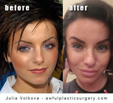 julia-volkova-plastic-surgery-before-and-after.jpg